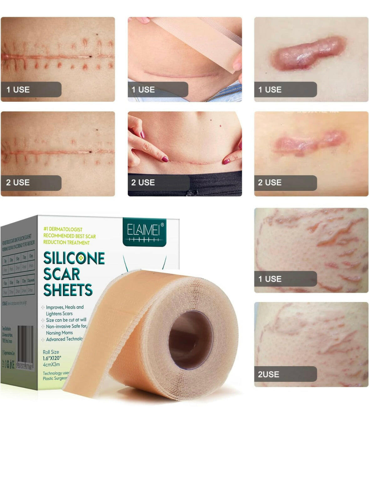 Silicone Scar Sheets (1.6” x 120” Roll-3M).