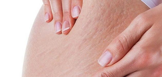 How do I get rid of stretch marks ?