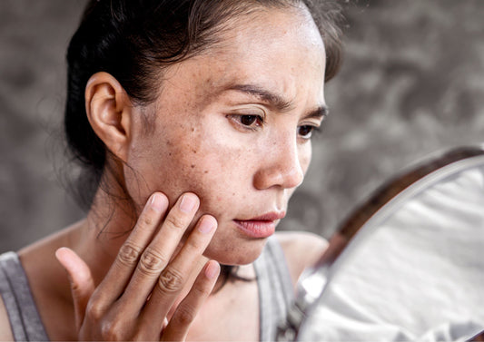 Melasma in pregnancy: Causes, Prevention, and Treatment