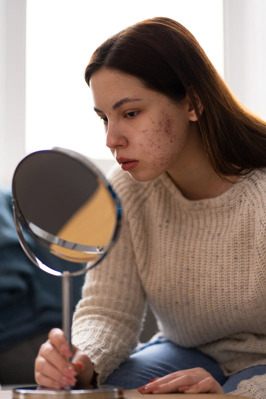 Pimples-During-Pregnancy