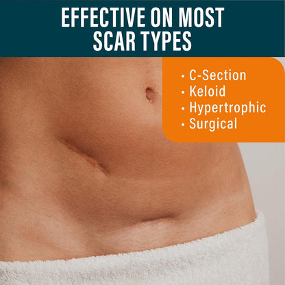 Nuvadermis Silicone Scar Sheets - Extra Long Scar Sheets for C-Section, Tummy Tuck, Keloid, and Surgical Scars - Reusable Medical Grade Silicone Scar Sheets - Pack of 4