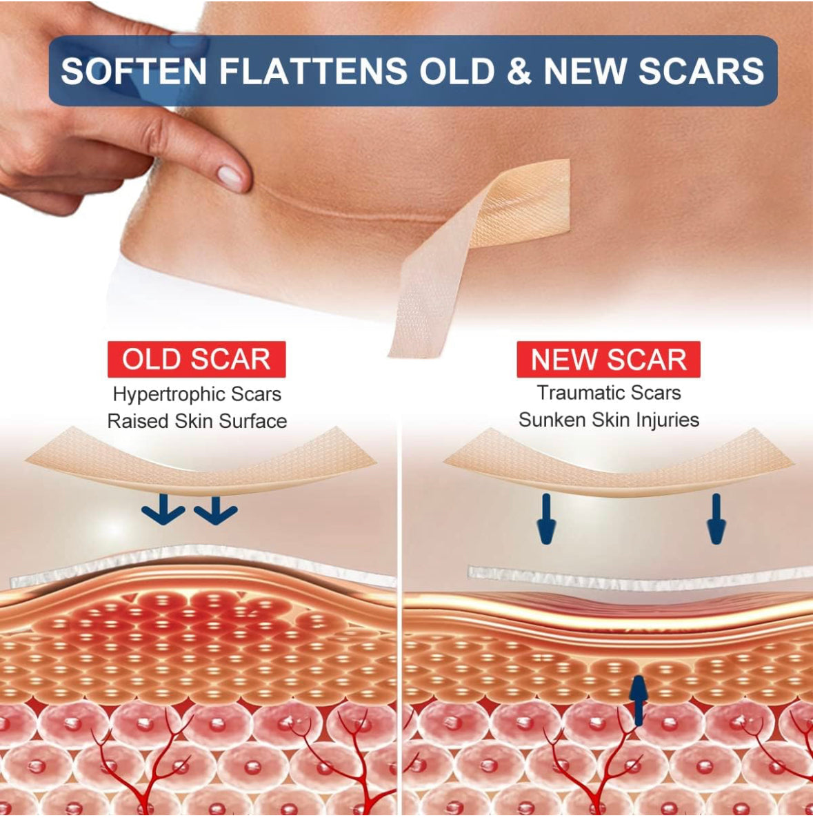 Silicone Scar Sheets (1.6” x 120” Roll-3M).