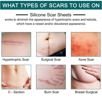 Silicone Scar Sheets (1.6” x 120” Roll-3M).