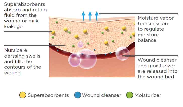 Nursicare PolyMem Therapeutic Breast Pads for Wounded, Cracked, Painful Nipples - Pack of 6